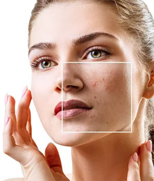 Acne Solution - service image